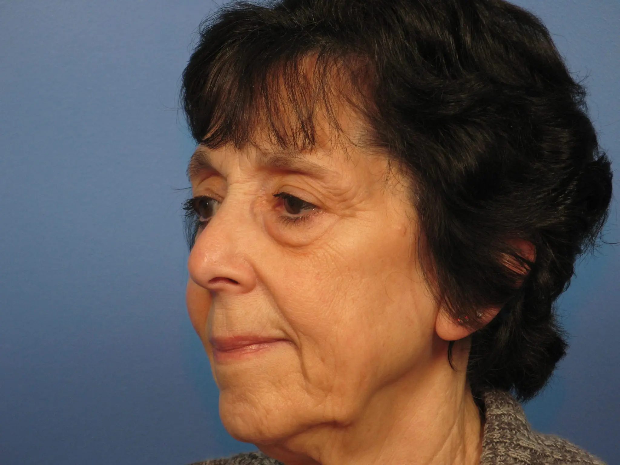 Upper and Lower Blepharoplasty