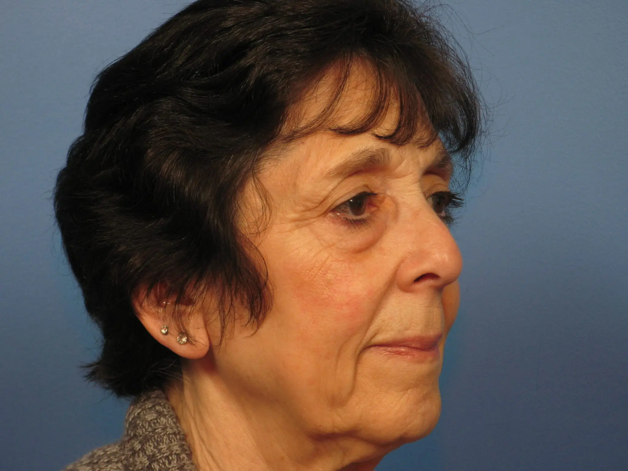 Upper and Lower Blepharoplasty