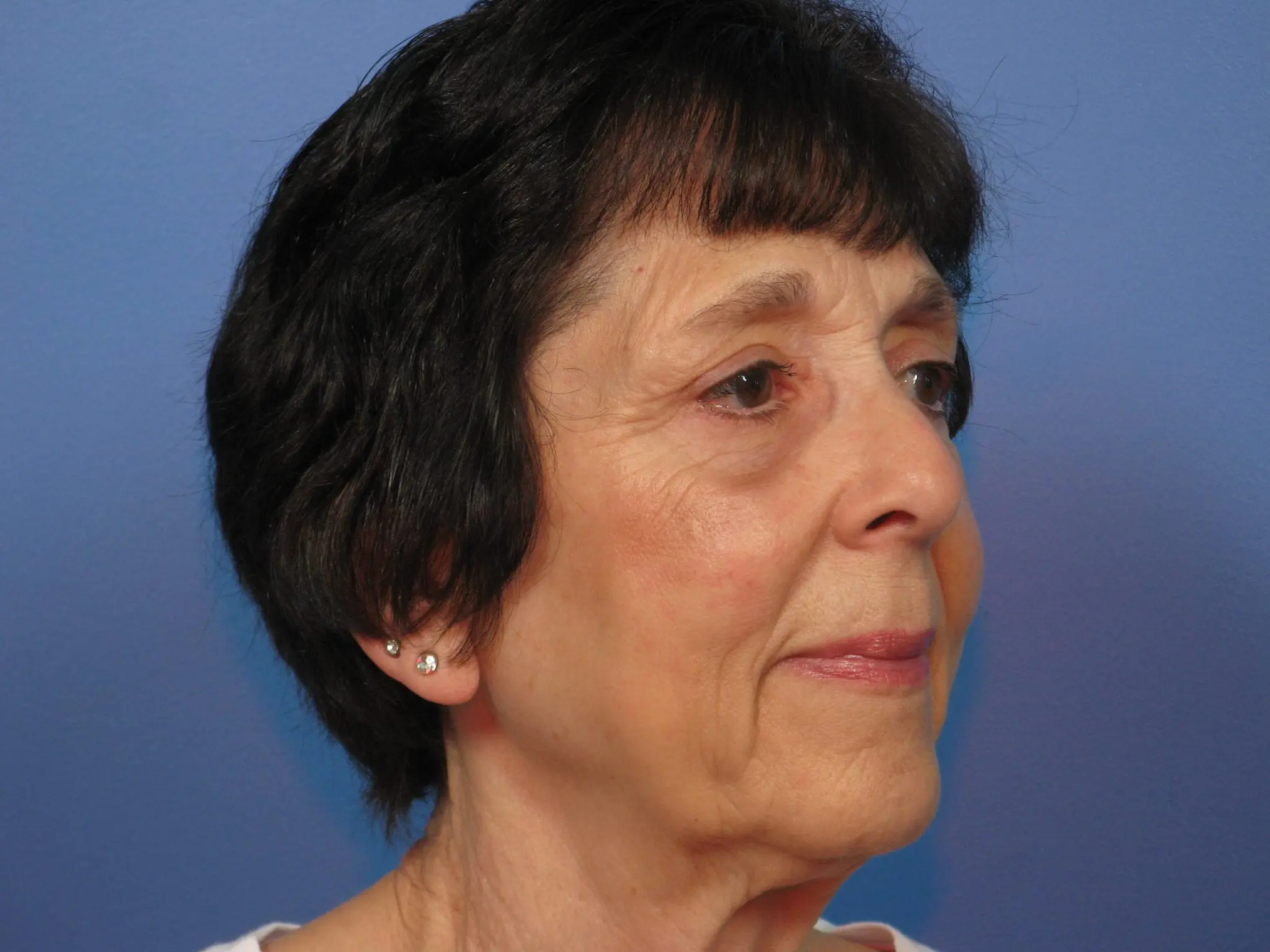 Upper and Lower Blepharoplasty