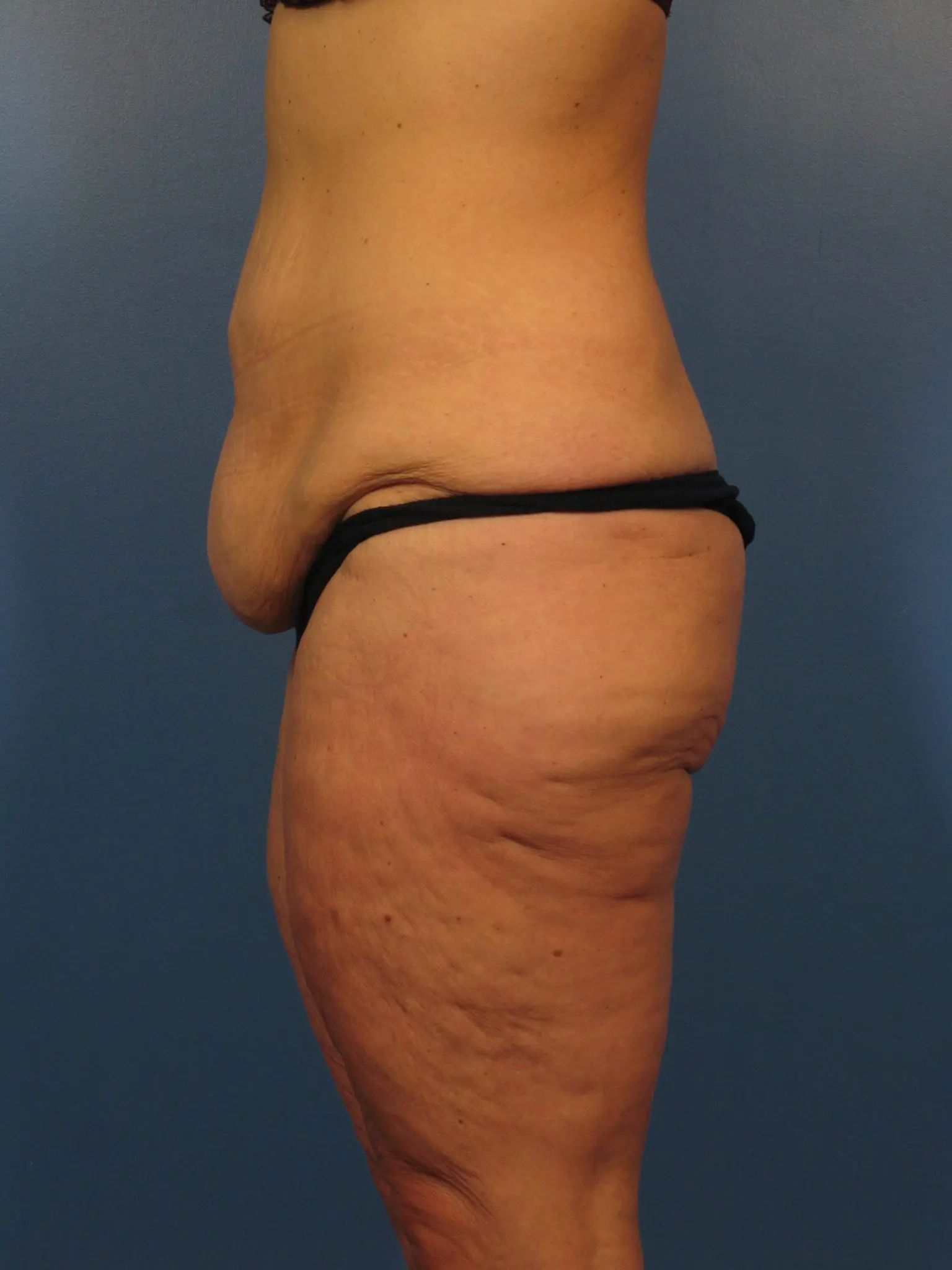 After: Surgery after major weight loss, Belt Lipectomy