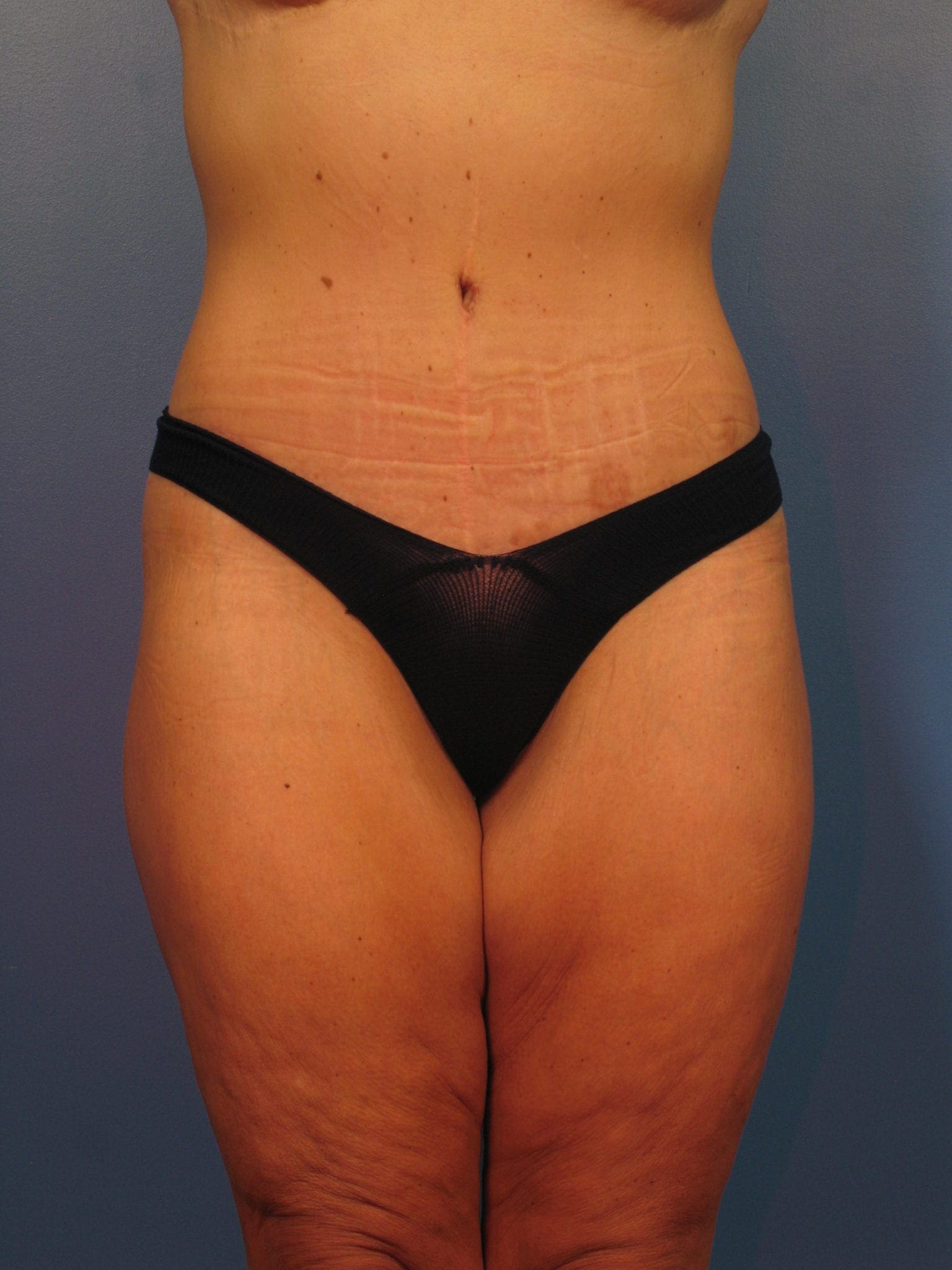 After: Surgery after major weight loss, Belt Lipectomy