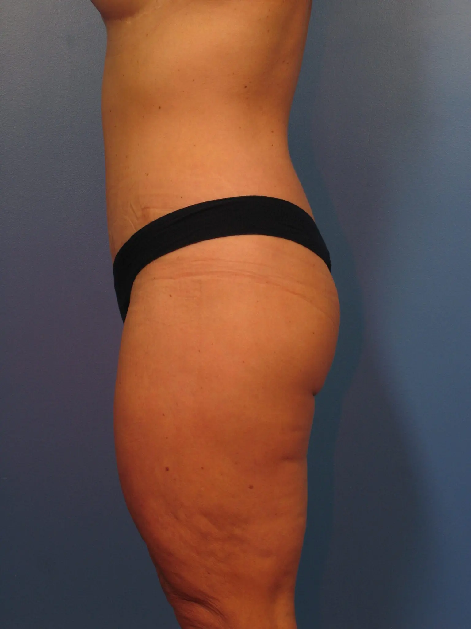 After: Surgery after major weight loss, Belt Lipectomy