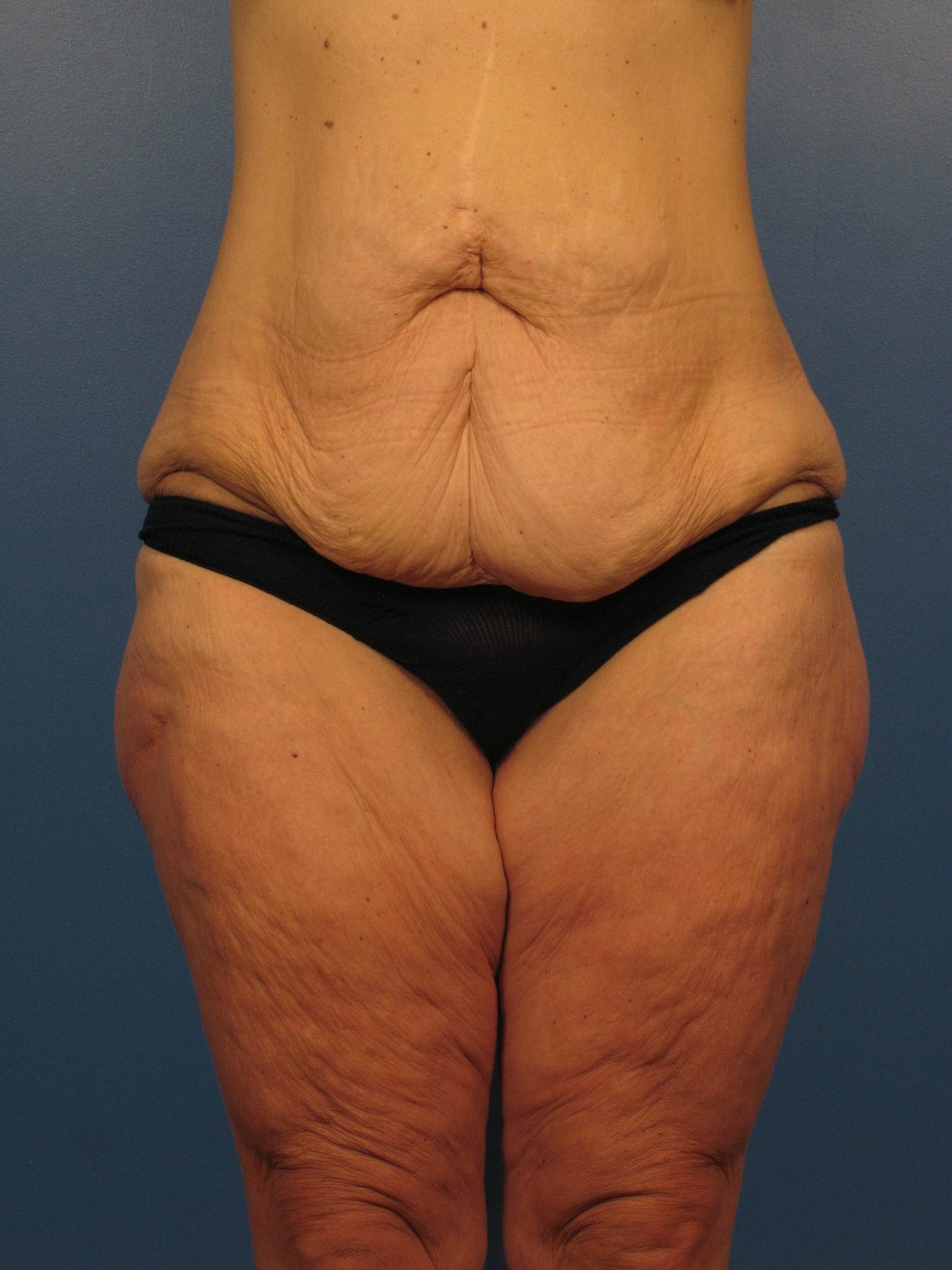 After: Surgery after major weight loss, Belt Lipectomy