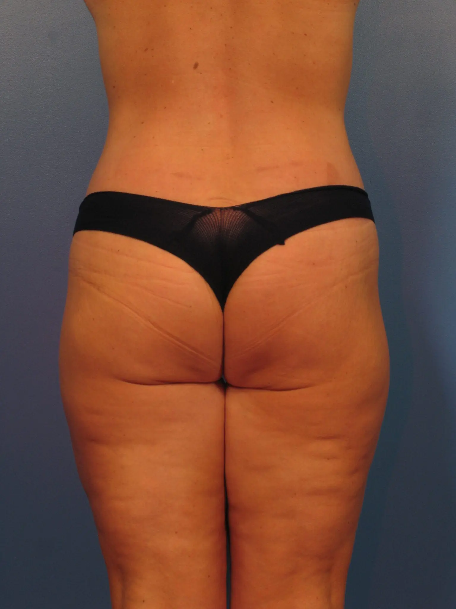 Before and After: Surgery after major weight loss, Belt Lipectomy