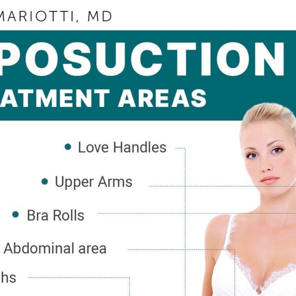 Liposuction Treatment Areas [Infographic]