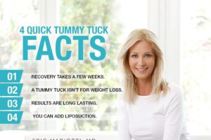 4 Quick Tummy Tuck Facts [Infographic]