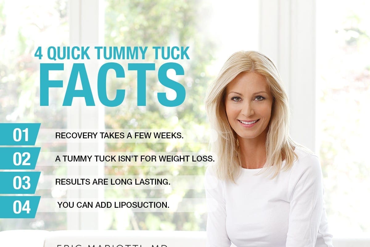 4 Quick Tummy Tuck Facts [Infographic] | MBody by Dr. Eric Mariotti ...