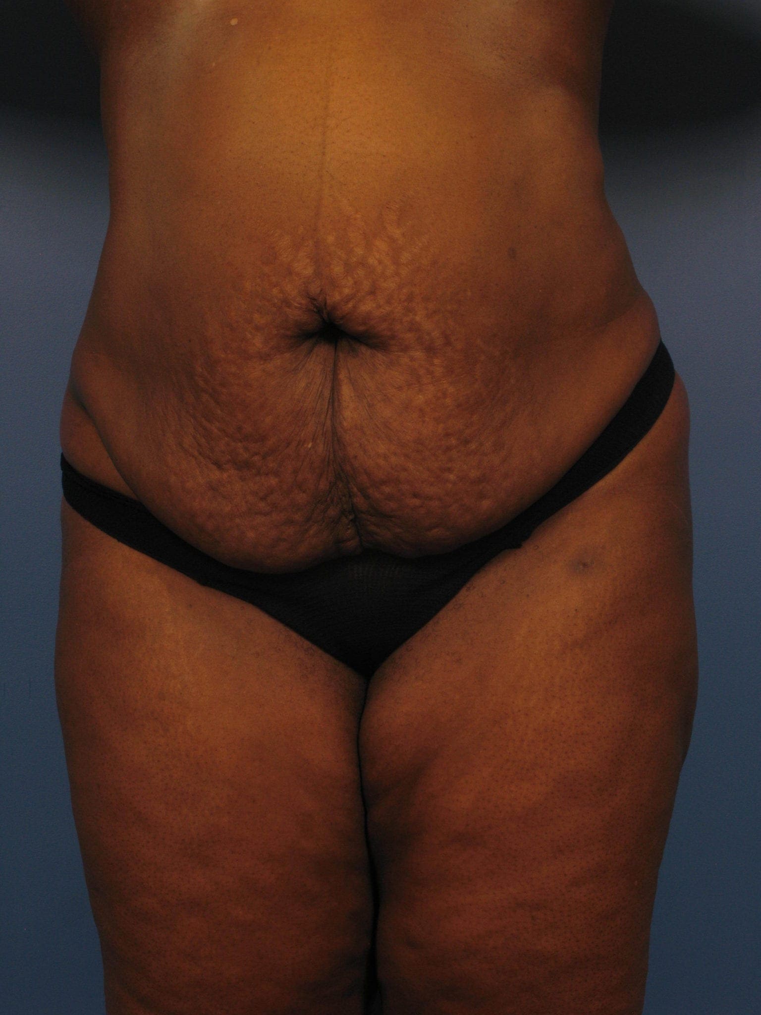 Mommy Makeover, tummy tuck