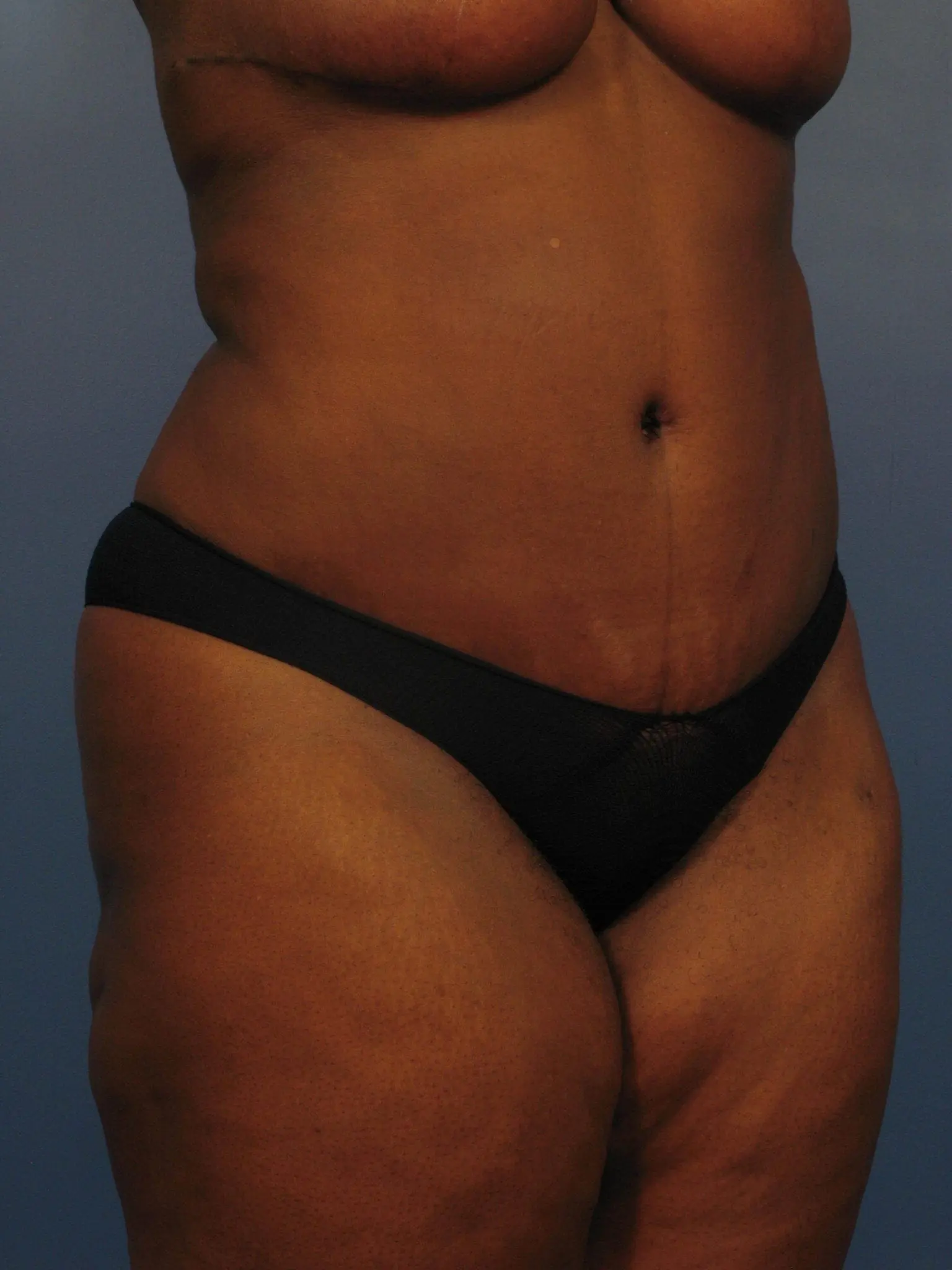 Mommy Makeover, tummy tuck