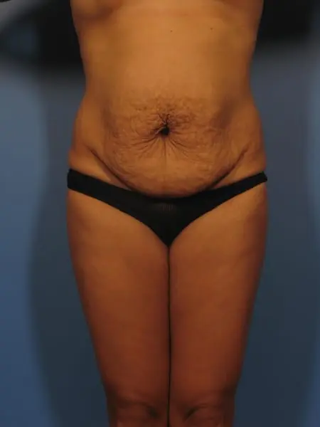 Mommy Makeover, Breast Lift before and after photos