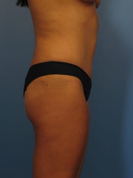 Mommy Makeover, Breast Lift before and after photos