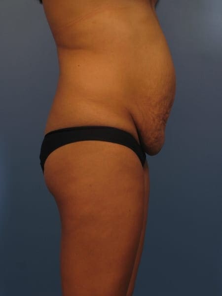 Mommy Makeover, Breast Lift before and after photos