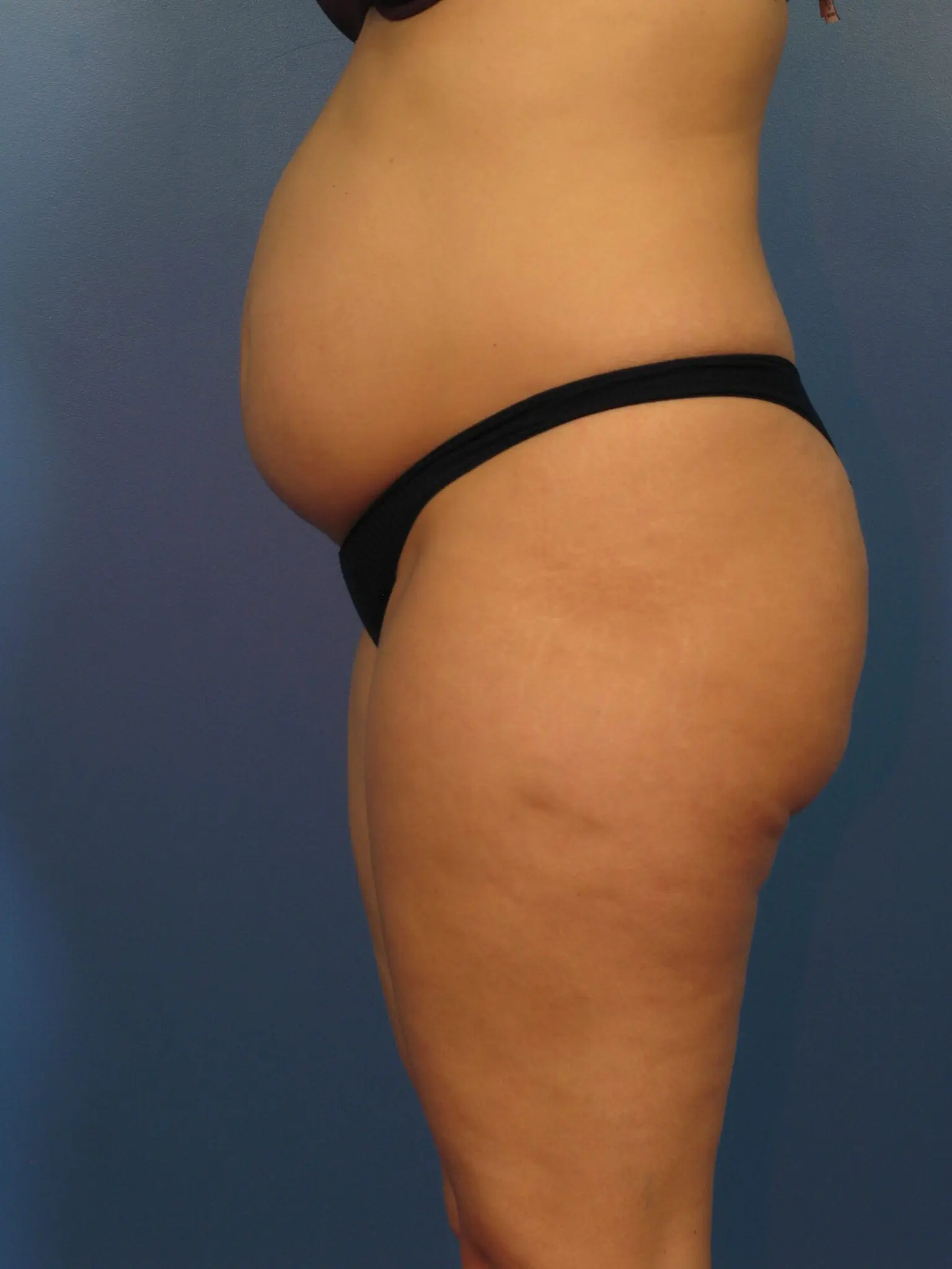 Before a Tummy Tuck