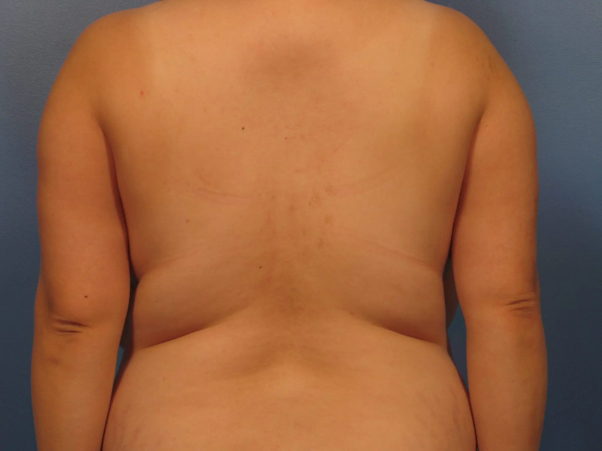 Before Liposuction of the Bra Roll