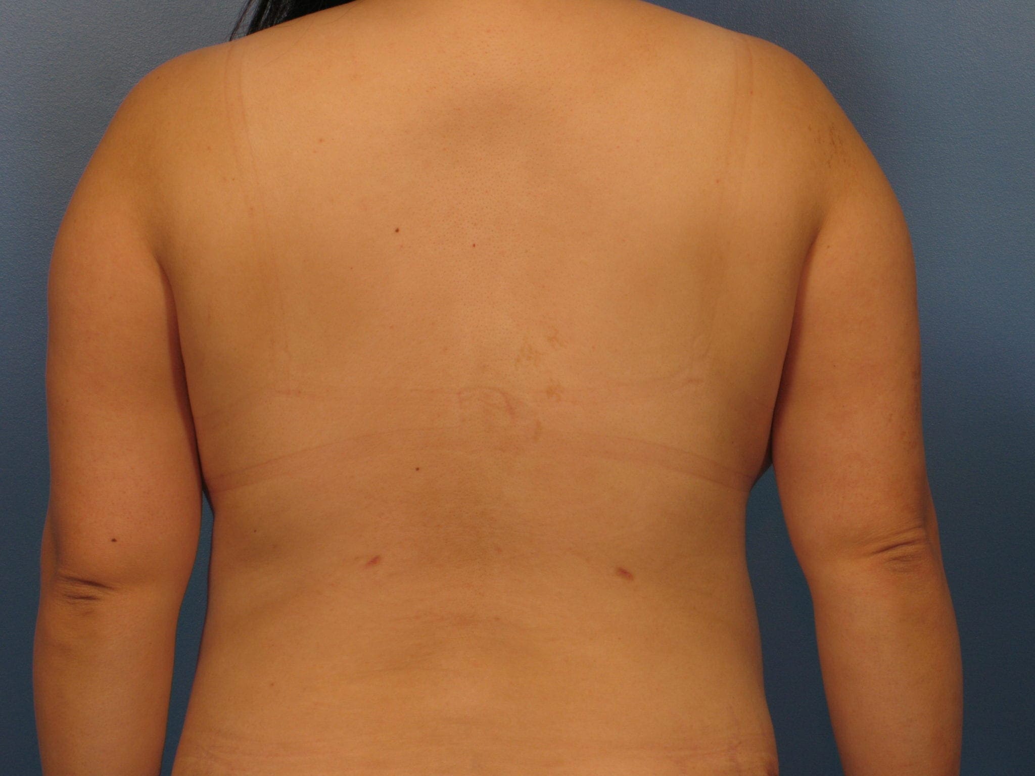 After Liposuction of the Bra Roll