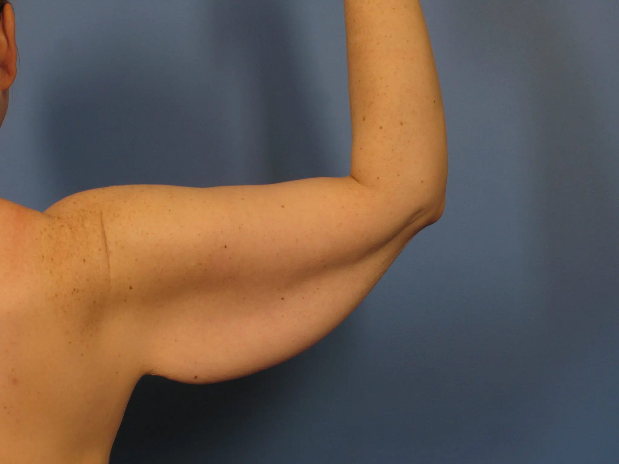 Before: Arm Lift (Brachioplasty)