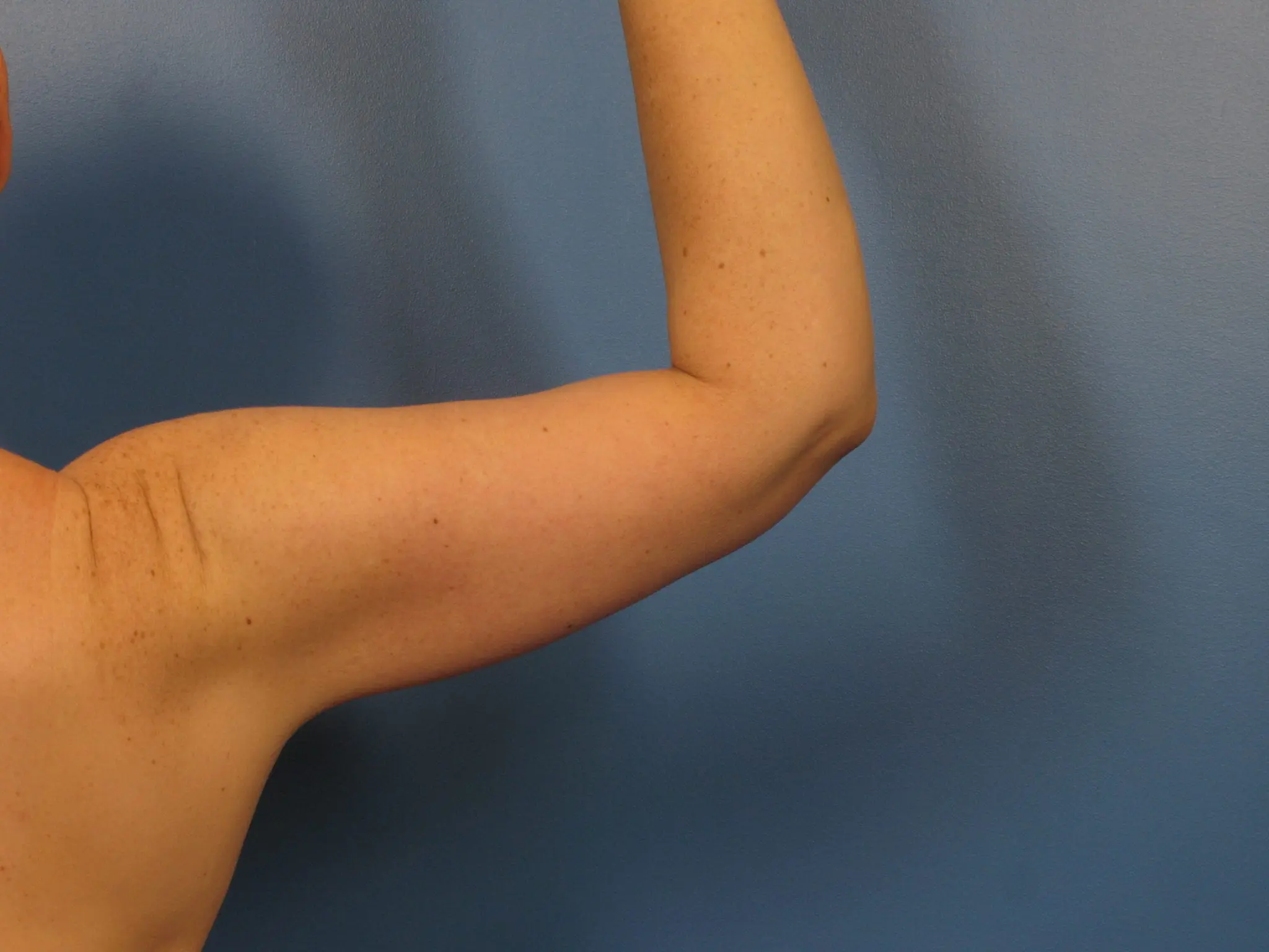 After: Arm Lift (Brachioplasty)