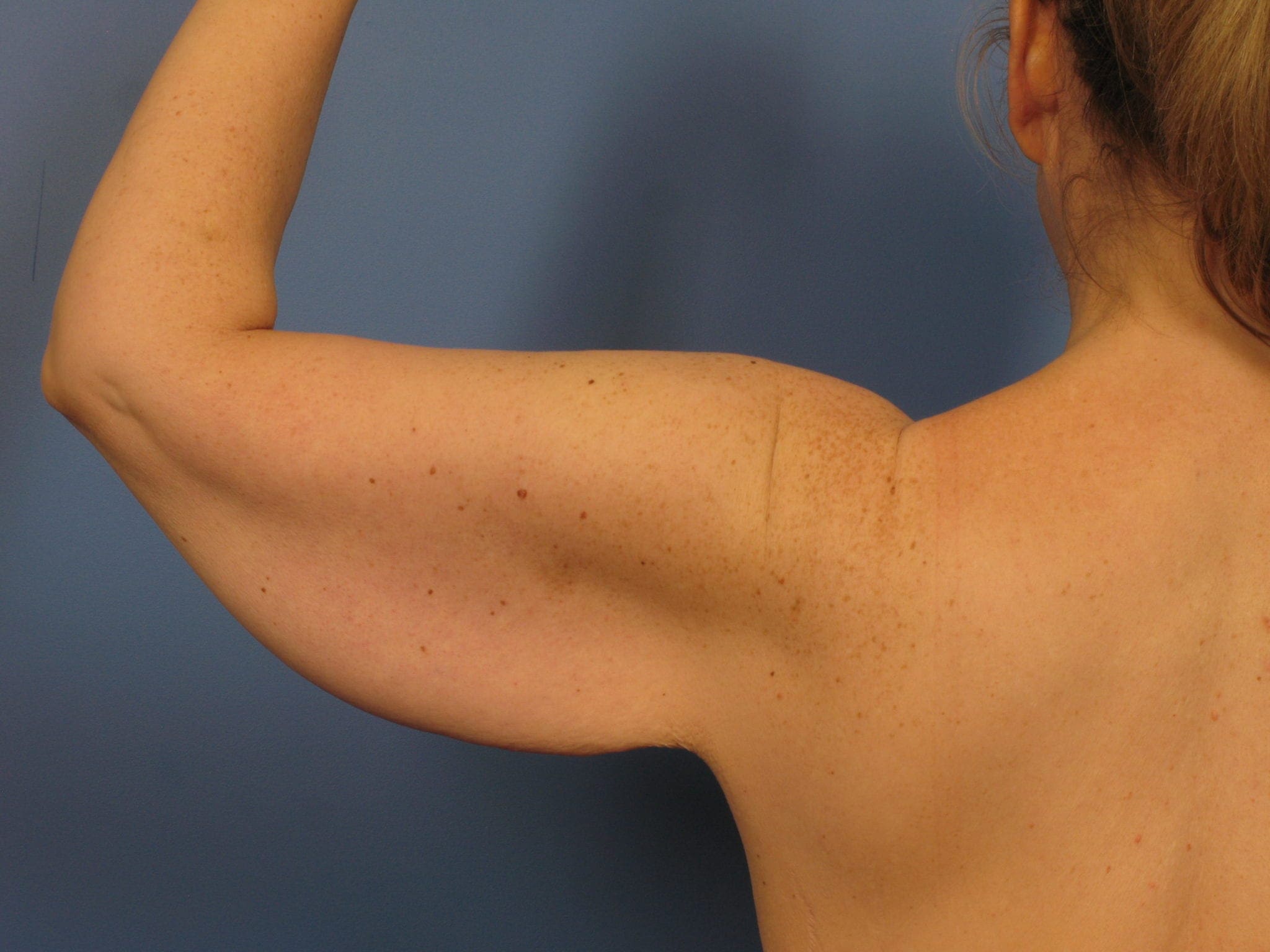 Before: Arm Lift (Brachioplasty)