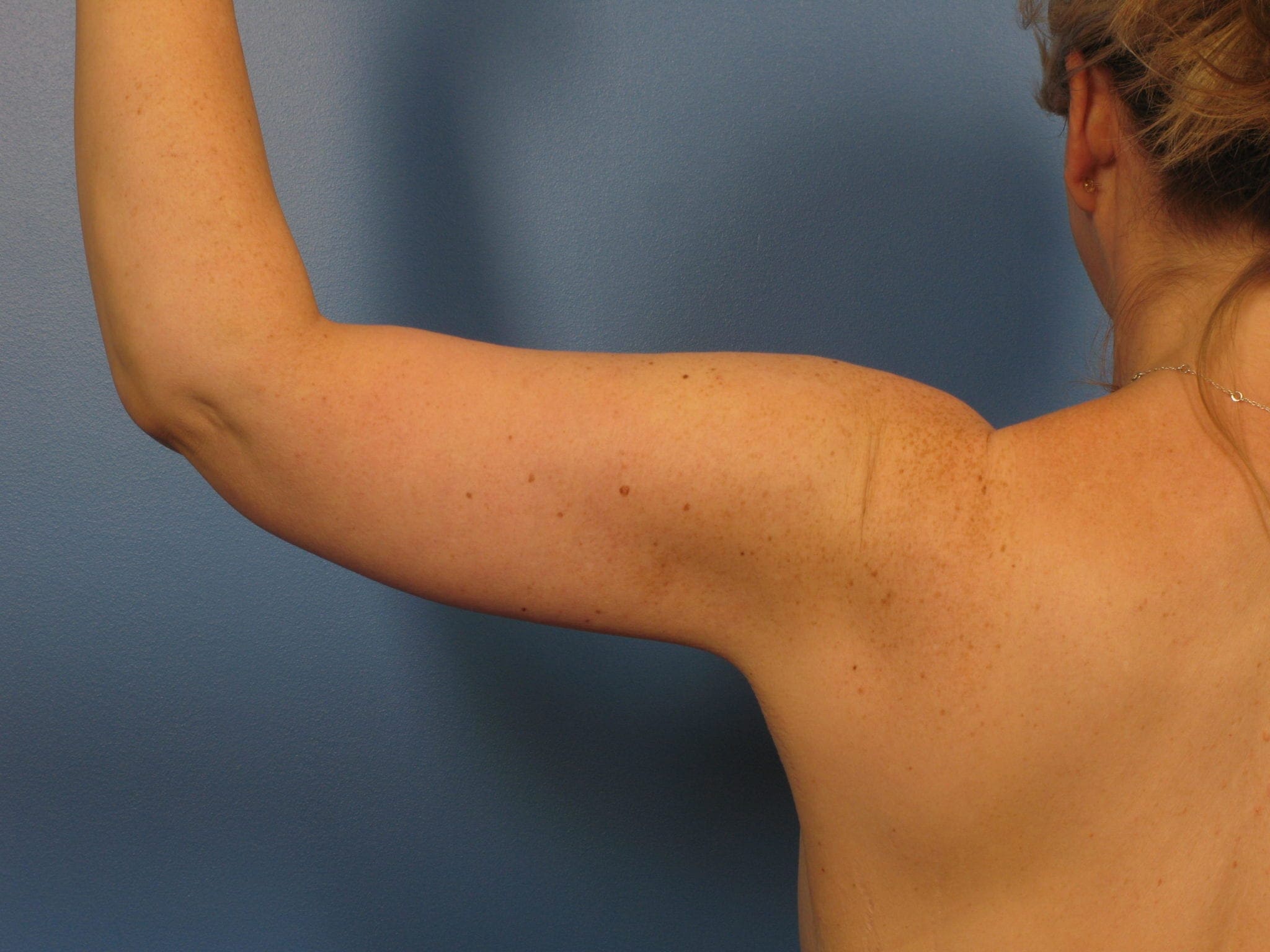 After: Arm Lift (Brachioplasty)