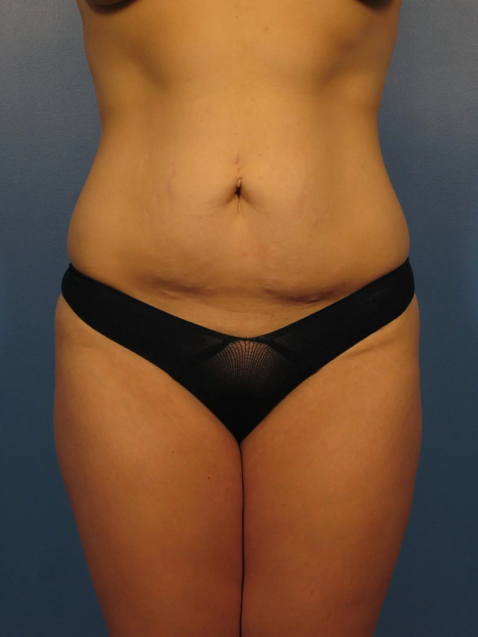 Before: Tummy Tuck