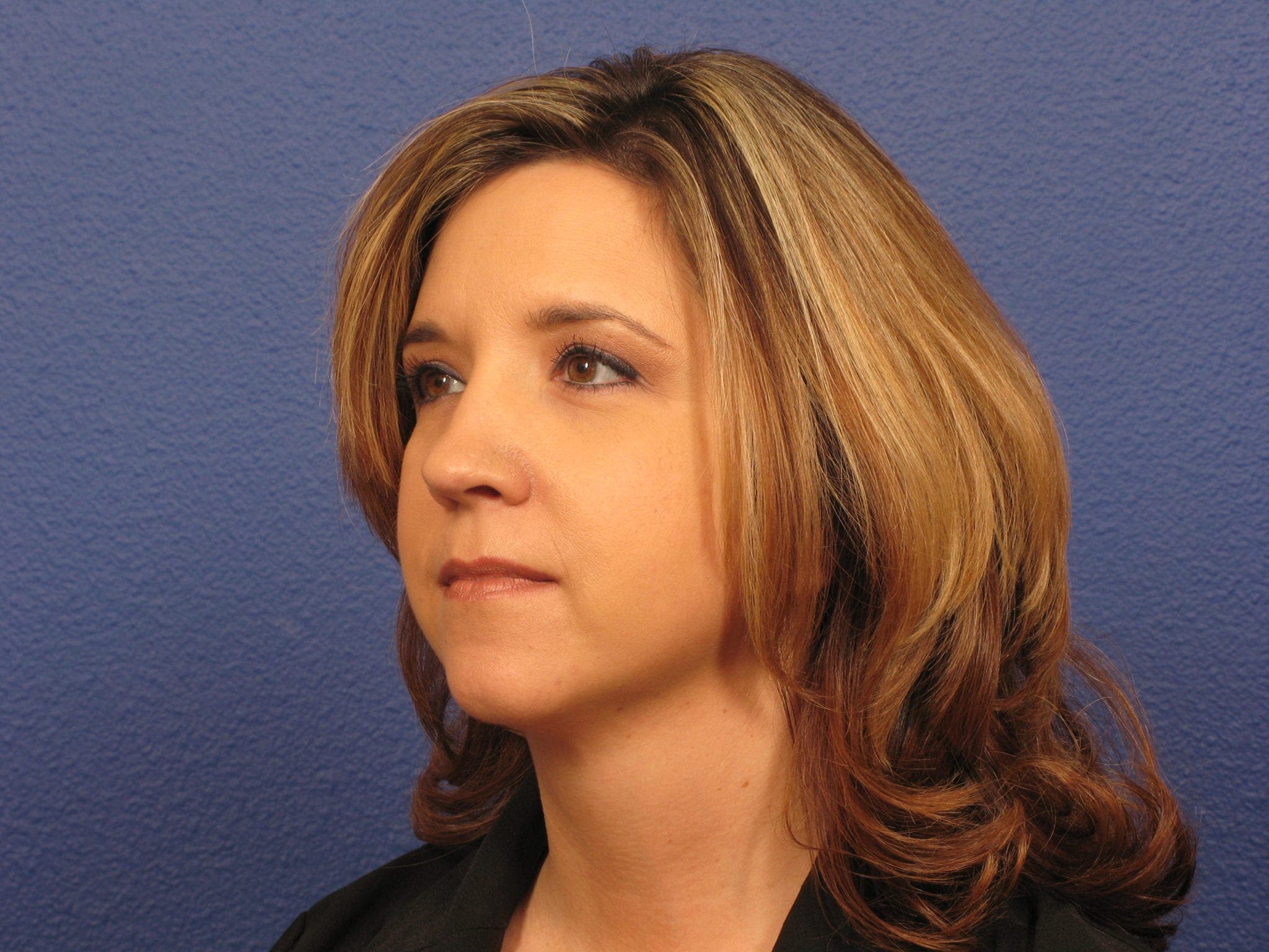 Chin Contouring, Submental Liposuction and VASER