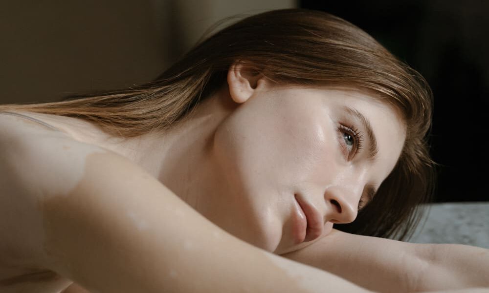 woman with skin discoloration