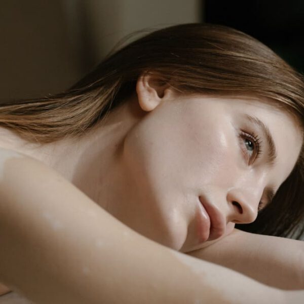woman with skin discoloration